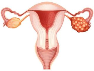 卵巢癌发现即晚期？医生：早期身体出现这4个信号，需及时就医！
