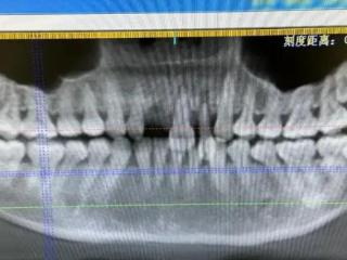 一晚上好几例！有人磕掉3颗门牙！医生：建议泡在牛奶里