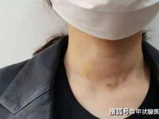 桥本病伴甲状腺结节会癌变吗？医生给出4点呵护甲状腺的建议