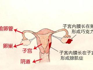 #学习分享424#日常如何预防子宫内膜异位症？