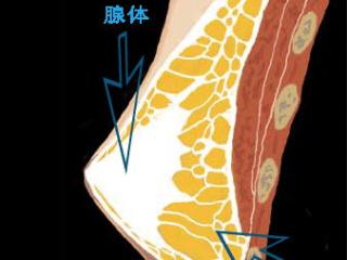 大部分的男性乳腺发育都是脂肪+腺体的组合