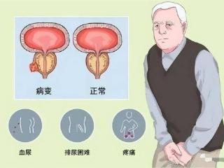 尿毒症是喝出来的？医生：即使是铁打的肾，这3种水也要少喝！