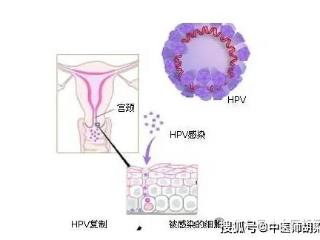 人乳头瘤病毒(HPV)感染多属湿热下注，清热利湿排毒法可治