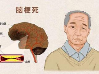 脑梗是“拖”出来的？医生：睡觉时若有3个症状，建议早筛查