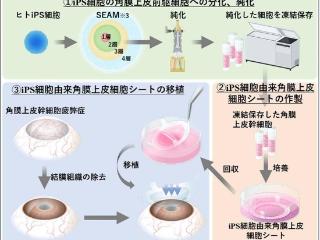 4人得以重见光明：大阪大学首次利用iPS再生组织修复LSCD患者角膜