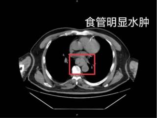 一口烫肿食管，男子吐血休克！“趁热吃”可能致癌