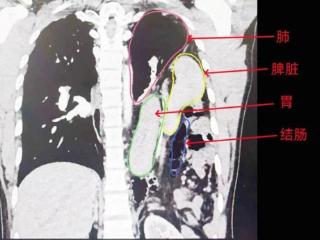 离奇！男子肠胃乱入胸腔十余年，医生提醒：这种情况一定要定期复查