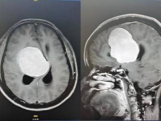 头晕加重、思维反应变迟钝，竟因颅内巨大肿瘤！医生花8小时精准切除