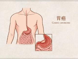 这一癌症为啥找上年轻人，这些事情要注意→